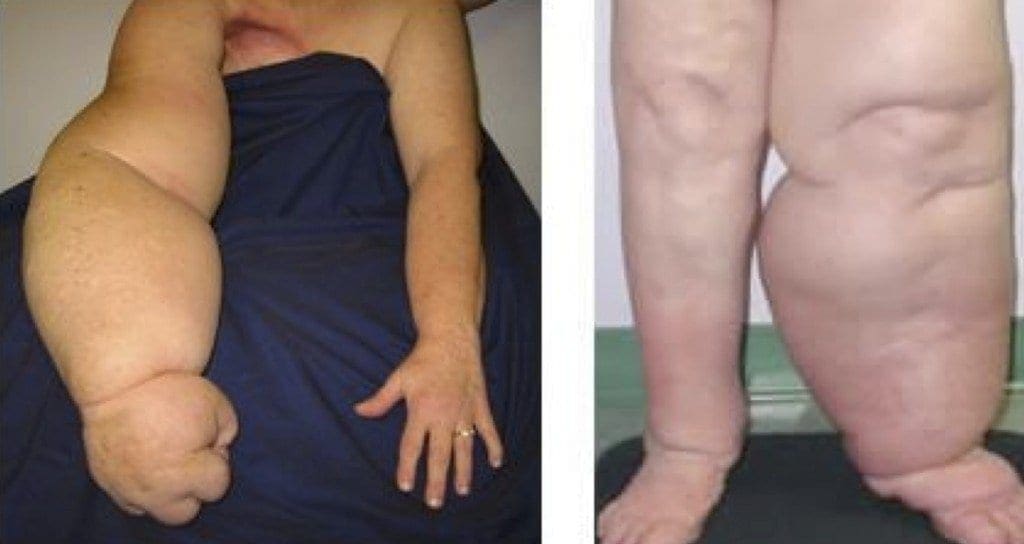 Untreated or Under-treated Lymphedema